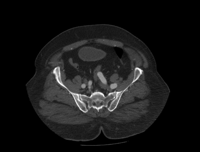 File:Aortic dissection (Radiopaedia 28802-29105 A 87).jpg