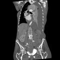 Aortic dissection (Radiopaedia 68763-78691 B 21).jpeg