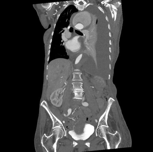 File:Aortic dissection (Radiopaedia 68763-78691 B 21).jpeg
