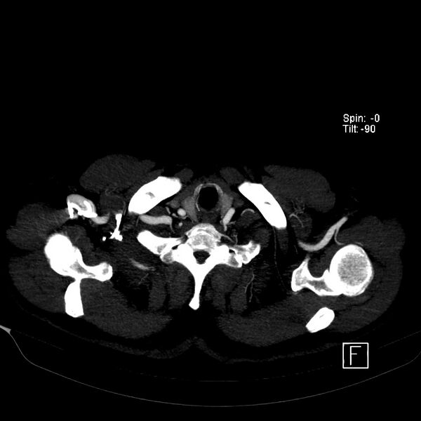 File:Aortic dissection - De Bakey type III - Stanford B (Radiopaedia 21903-21882 B 4).jpg