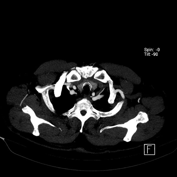 File:Aortic dissection - De Bakey type III - Stanford B (Radiopaedia 21903-21882 B 8).jpg