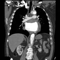 Aortic dissection with rupture into pericardium (Radiopaedia 12384-12647 B 23).jpg