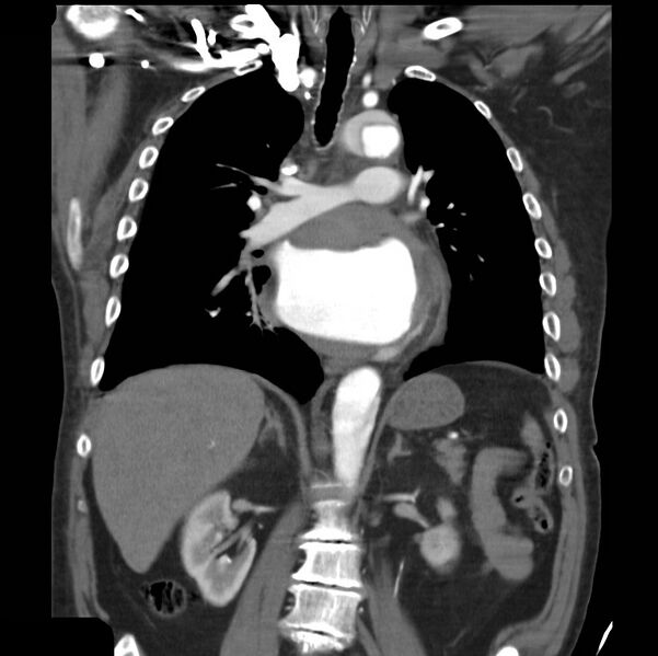 File:Aortic dissection with rupture into pericardium (Radiopaedia 12384-12647 B 23).jpg