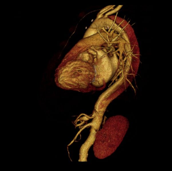 File:Aortic dissection with rupture into pericardium (Radiopaedia 12384-12647 D 28).jpg