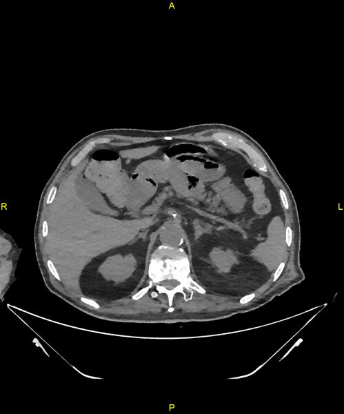 File:Aortoenteric fistula (Radiopaedia 84308-99603 Axial non-contrast 79).jpg
