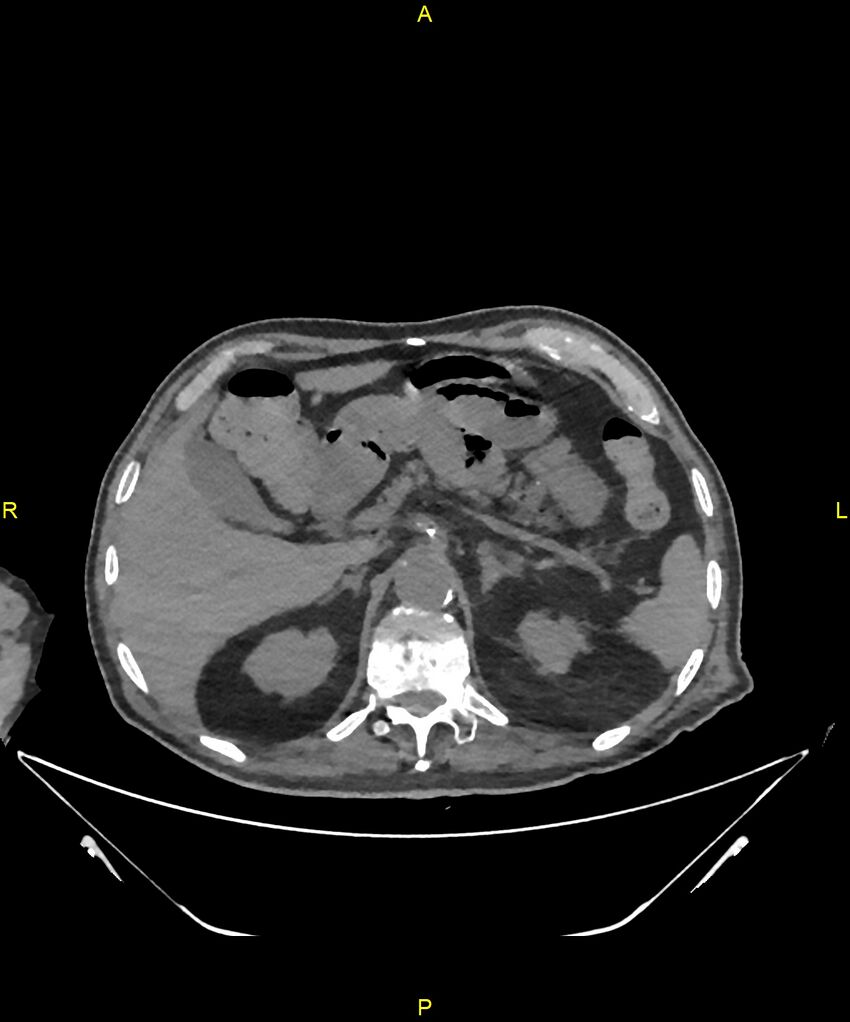 Aortoenteric fistula (Radiopaedia 84308-99603 Axial non-contrast 79).jpg
