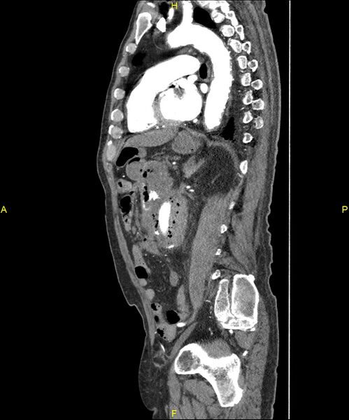 File:Aortoenteric fistula (Radiopaedia 84308-99603 C 211).jpg