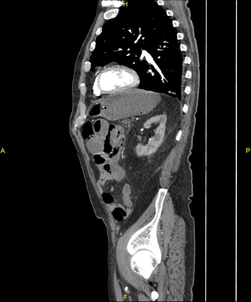 File:Aortoenteric fistula (Radiopaedia 84308-99603 C 248).jpg