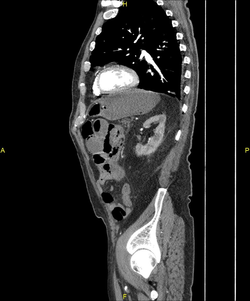 Aortoenteric fistula (Radiopaedia 84308-99603 C 248).jpg