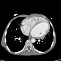 Aortopulmonary window, interrupted aortic arch and large PDA giving the descending aorta (Radiopaedia 35573-37074 B 60).jpg