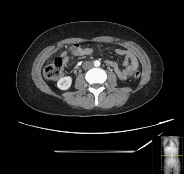 File:Appendicitis (CT angiogram) (Radiopaedia 154713-127660 Axial 77).jpg
