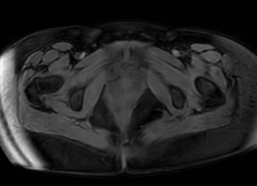 Appendicitis in gravida (MRI) (Radiopaedia 89433-106395 Axial DIXON 150).jpg