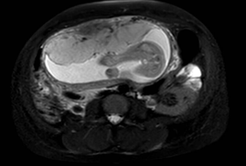 File:Appendicitis in gravida (MRI) (Radiopaedia 89433-106395 Axial T2 SPAIR 40).jpg