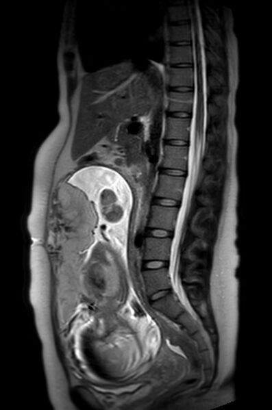 File:Appendicitis in gravida (MRI) (Radiopaedia 89433-106395 Sagittal T2 33).jpg