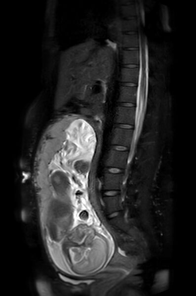 File:Appendicitis in gravida (MRI) (Radiopaedia 89433-106395 Sagittal T2 SPAIR 30).jpg