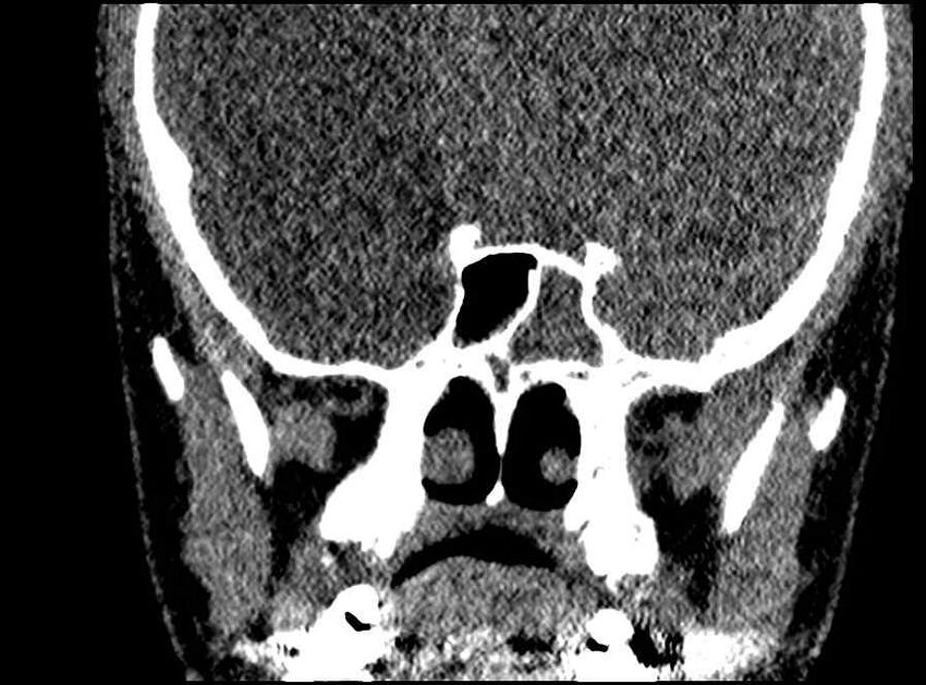 Arachnoid cyst- extremely large (Radiopaedia 68741-78450 Coronal bone window 25).jpg