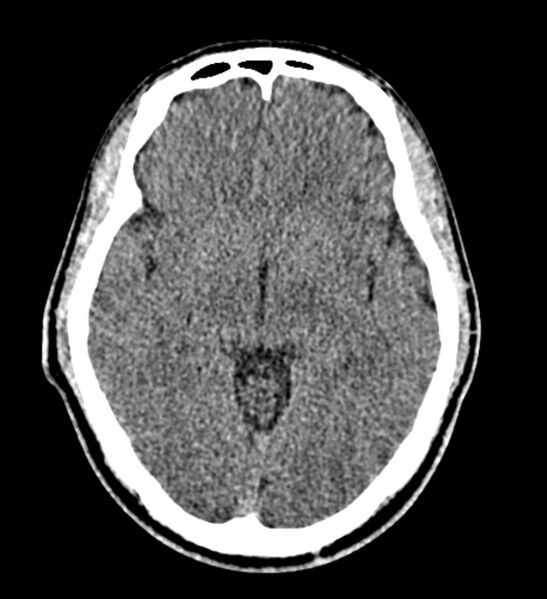 File:Arachnoid cyst of the ambient cistern (Radiopaedia 81301-94986 Axial non-contrast 33).jpg