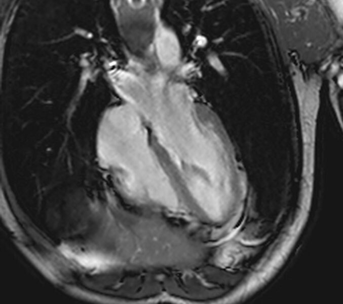 File:Arrhythmogenic right ventricular cardiomyopathy (Radiopaedia 39806-42237 D 91).jpg