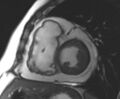 Arrhythmogenic right ventricular cardiomyopathy (Radiopaedia 69431-79307 Short axis cine 130).jpg