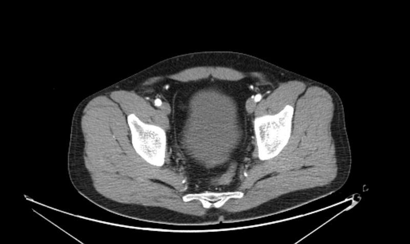 File:Arterial occlusive mesenteric ischemia (Radiopaedia 84641-100060 A 116).jpg