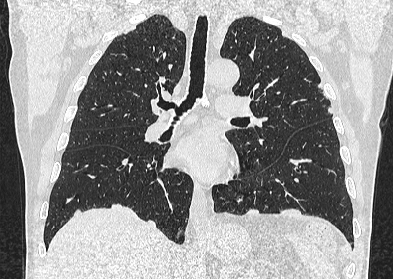 File:Asbestos pleural placques (Radiopaedia 57905-64872 Coronal lung window 152).jpg