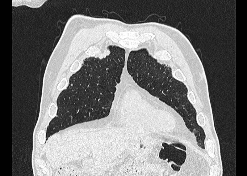 File:Asbestos pleural placques (Radiopaedia 57905-64872 Coronal lung window 38).jpg