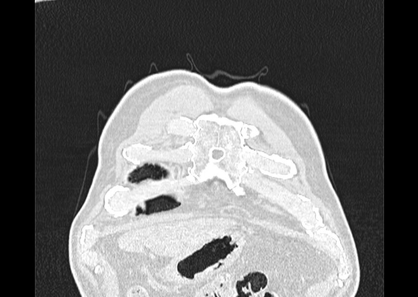 Asbestos pleural placques (Radiopaedia 57905-64872 Coronal lung window 7).jpg