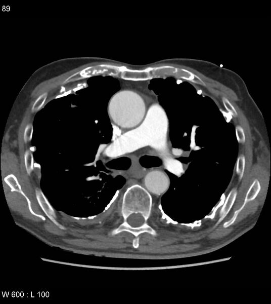 File:Asbestos related lung and pleural disease (Radiopaedia 14377-14301 D 25).jpg