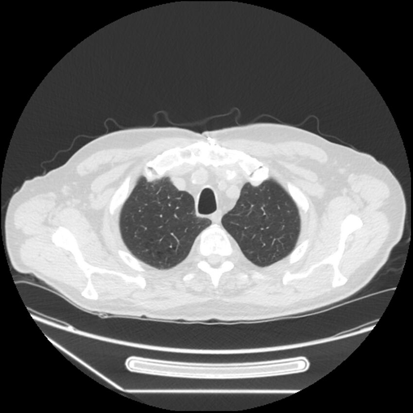 Asbestosis complicated by lung cancer (Radiopaedia 45834-50116 Axial lung window 11).jpg