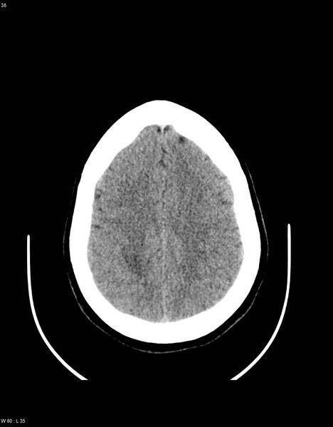 File:Astroblastoma (Radiopaedia 39792-42216 Axial non-contrast 37).jpg