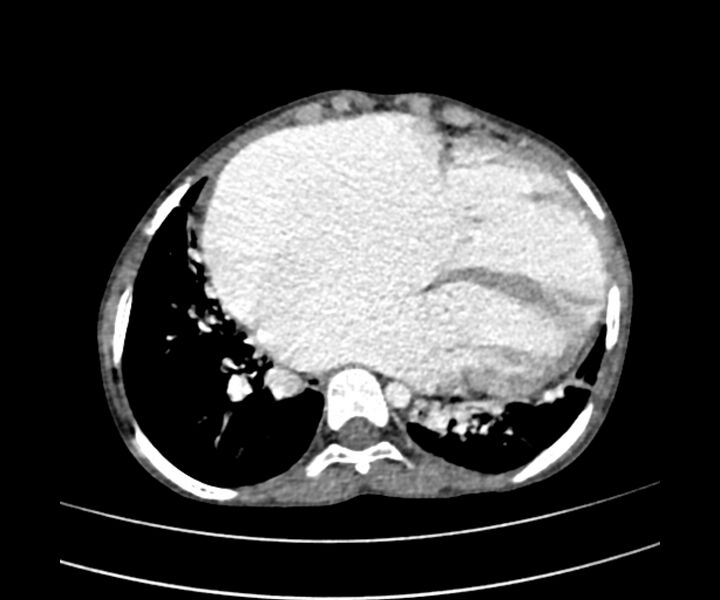 File:Atrial septal defect complicated by Eisenmenger syndrome (Radiopaedia 53707-59768 Axial C+ CTPA 22).jpg