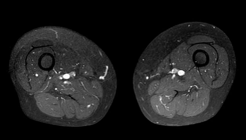 Atypical lipomatous tumor - thigh (Radiopaedia 68975-78734 Axial T1 C+ fat sat 44).jpg