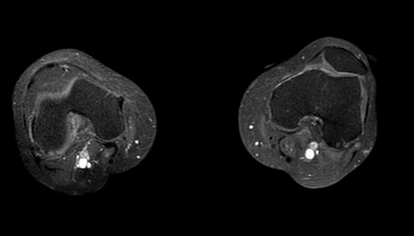 Atypical lipomatous tumor - thigh (Radiopaedia 68975-78734 Axial T1 C+ fat sat 9).jpg
