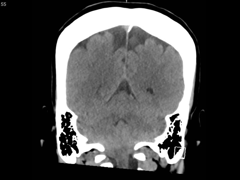 File:Atypical meningioma - intraosseous (Radiopaedia 64915-73867 B 54).jpg