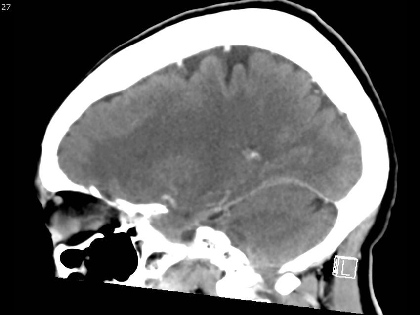 Atypical meningioma - intraosseous (Radiopaedia 64915-73867 F 26).jpg