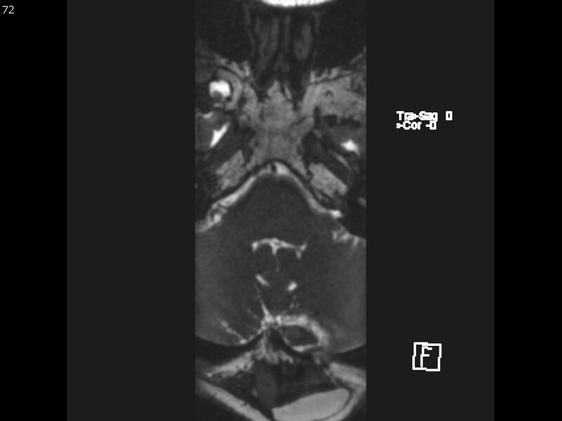 File:Atypical meningioma - intraosseous (Radiopaedia 64915-74572 Axial CISS 72).jpg