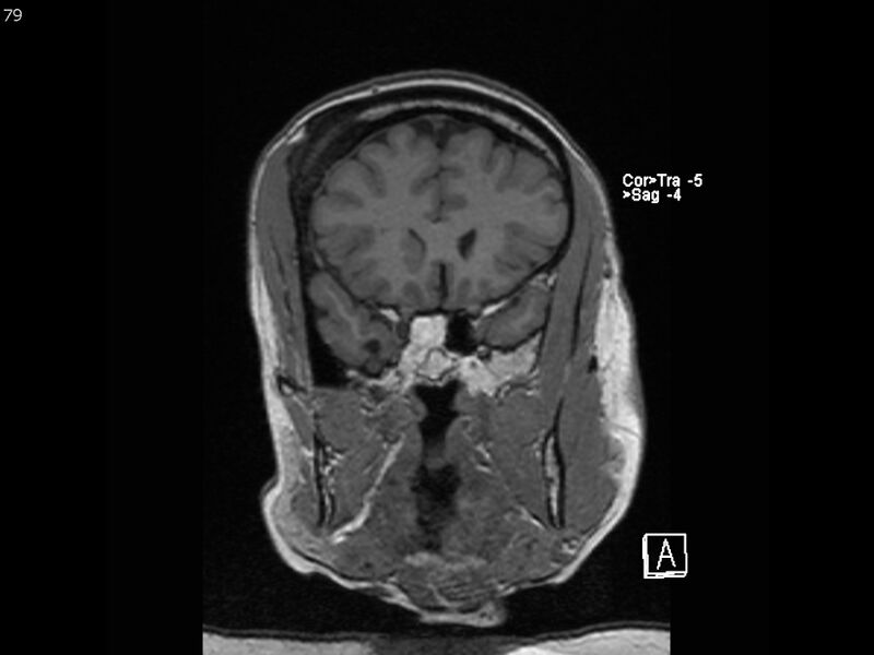 File:Atypical meningioma - intraosseous (Radiopaedia 64915-74572 Coronal T1 79).jpg