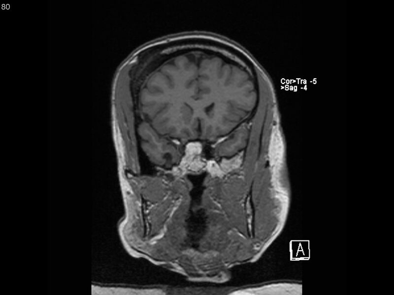 File:Atypical meningioma - intraosseous (Radiopaedia 64915-74572 Coronal T1 80).jpg