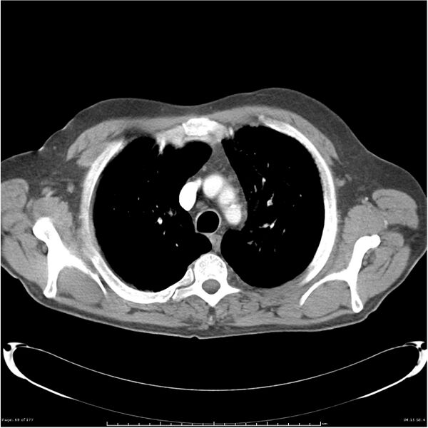 File:Atypical pneumonia - Q fever (Radiopaedia 21993-21989 C+ arterial phase 10).jpg