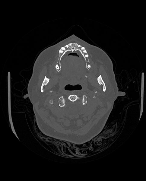 File:Automastoidectomy with labyrinthine fistula (Radiopaedia 84143-99411 Axial non-contrast 28).jpg