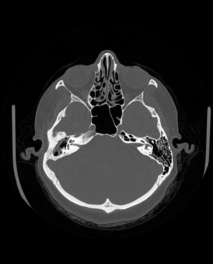Automastoidectomy with labyrinthine fistula (Radiopaedia 84143-99411 Axial non-contrast 89).jpg