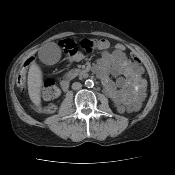 File:Autosomal dominant polycystic kidney disease (Radiopaedia 27851-28094 Axial non-contrast 74).jpg