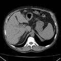 Autosomal dominant polycystic kidney disease (Radiopaedia 36539-38101 Axial non-contrast 20).jpg