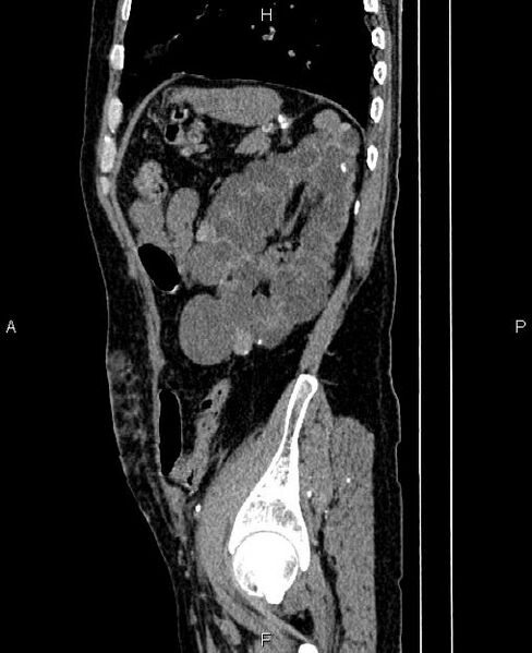 File:Autosomal dominant polycystic kidney disease (Radiopaedia 87830-104287 C 72).jpg