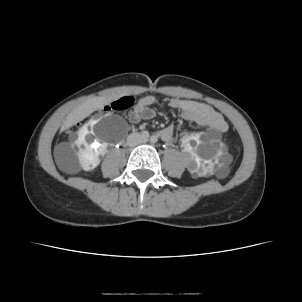 File:Autosomal dominant polycystic kidney disease - early onset (Radiopaedia 40734-43387 D 12).jpg