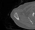 Avulsion fracture - greater tuberosity of humerus (Radiopaedia 71216-81514 Axial bone window 15).jpg