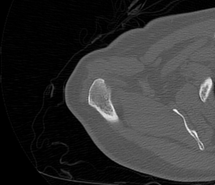 File:Avulsion fracture - greater tuberosity of humerus (Radiopaedia 71216-81514 Axial bone window 15).jpg