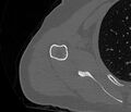 Avulsion fracture - greater tuberosity of humerus (Radiopaedia 71216-81514 Axial bone window 56).jpg