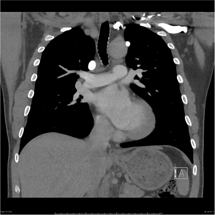 Azygos venous system anatomy (CT pulmonary angiography) (Radiopaedia 25928-26077 Coronal C+ CTPA 37).jpg