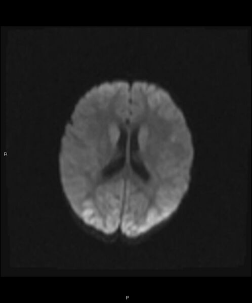 File:Basal ganglia and parenchymal ischemia (Radiopaedia 45818-50084 Axial DWI 15).jpg